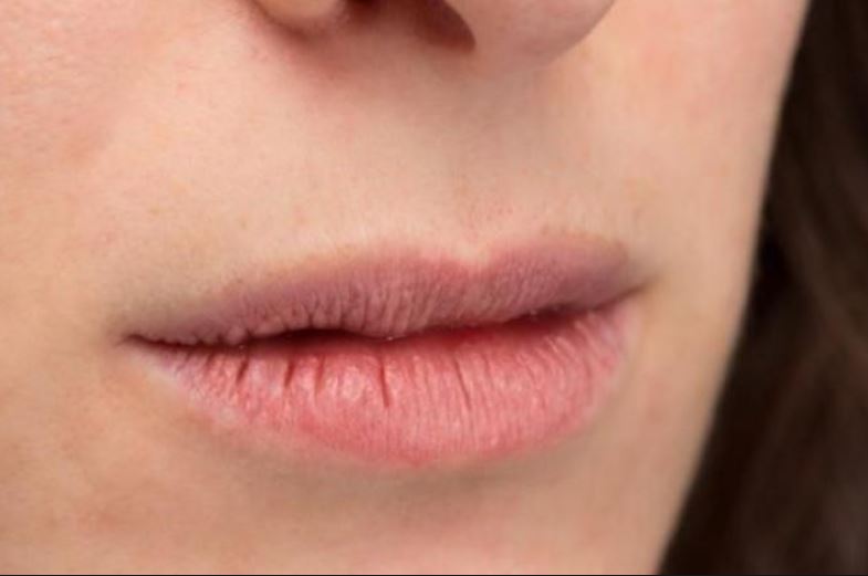 dry lips of diabetes patient