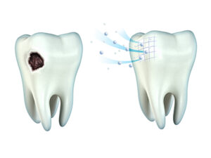 Teeth_Cavity