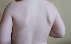 measles and chickenpox