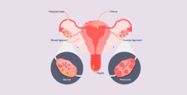 pcos