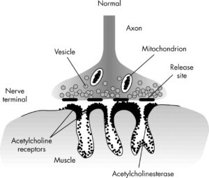 maysthenia gravis